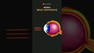 Nearsightedness or Myopia 👁️‍🗨️ shorts youtubeshorts ytshorts shortsfeed lens eye physics [upl. by Tiebout]