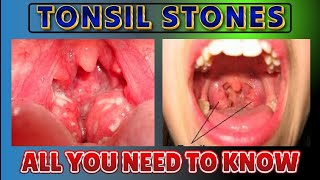 Tonsil Stones  Tonsil Stones Treatment  Tonsil Stone Removal  All You Need to Know [upl. by Nomahs925]