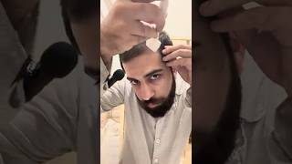 Hair Restoration day40 by Derma Stamp minoxidil haircare [upl. by Allyn]