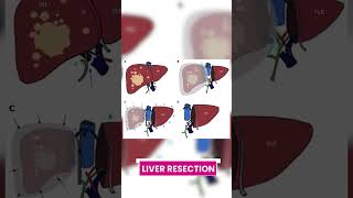 Exploring Treatment Options for Liver Cancer  Dr Pallavi Redhu livercancer cancer treatment [upl. by Alaaj]