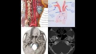 Part 2INTERNAL CAROTID ARTERYClinical amp Surgical anatomyReal time ArteriographyMRI amp CT Angio [upl. by Akemyt]