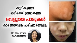 കുട്ടികളുടെ ശരീരത്ത് ഉണ്ടാകുന്ന വെളുത്ത പാടുകൾ What causes skin discoloration in kids  Health Tips [upl. by Aihtniroc]