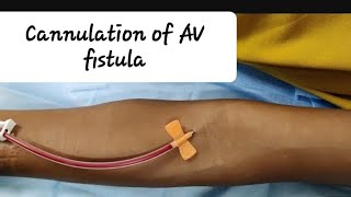 How to prick AV fistula First time Cannulation of AV fistula and Assessment [upl. by Kylila756]