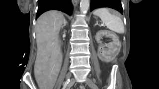 Renal cortical necrosis on CT [upl. by Anna-Diana692]