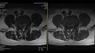 L45 Disc extrusion with mild inferior migration [upl. by Efram]