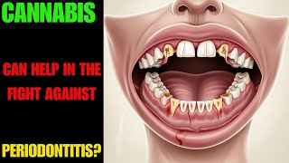 Cannabis vs Periodontitis A New Hope [upl. by Ahsas]