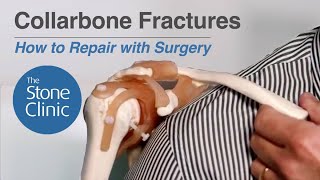 Collarbone Fractures MinimallyInvasive Surgical Repair [upl. by Eiramlehcar]