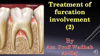 46 Periodontal surgery14 Furcation involvement2Dr Wadhah Periodontology lecturesد وضاح الحاج [upl. by Vashtee]