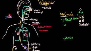 Wegener and Microscopic Polyangiitis [upl. by Edac]