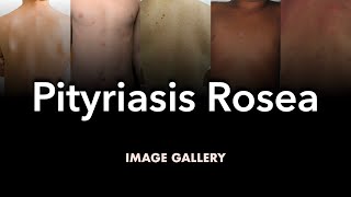 Pityriasis Rosea Image Gallery [upl. by Berner405]