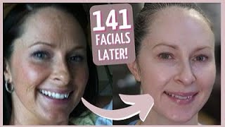 How Im Reversing UV Damage and Aging Skin  My Favorite Medspa Facials [upl. by Ling]