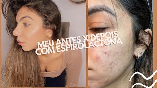 MEU ANTES E DEPOIS COM ESPIROLACTONA [upl. by Torp]