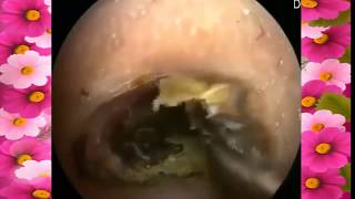 Ear wax removal Compilation 21 Ear Cleaning China Earwax cleaning CystAcneMucusindia ear cleaning [upl. by Barty]