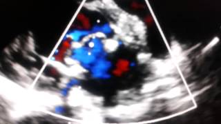 Echocardiogram  periprosthetic reflux leak in bioprosthetic mitral [upl. by Wakefield]