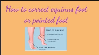 How to correct Equinus foot or pointed foot  Pinoy Physical Therapy [upl. by Island]