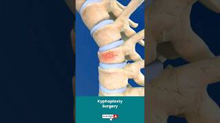 Spine Fracture Kyphoplasty ↪ 3D Medical Animation Shorts Kyphoplasty KyphoplastySurgery Spine [upl. by Eenobe]