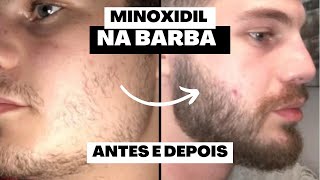 🔴 MINOXIDIL ANTES E DEPOIS DOS INSCRITOS  BARBA 2022  ALEX CURSINO [upl. by Olyhs]