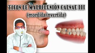 tipos de maloclusión clase III [upl. by Melli947]