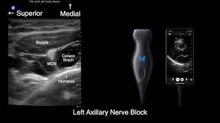 US anatomy for axillary nerve block with ButterflyIQ [upl. by Alejoa35]