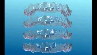 Information sur Invisalign [upl. by Uile]