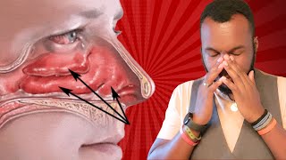 Eustachian Tube Dysfunction Unclog your ear instantly [upl. by Akiv]