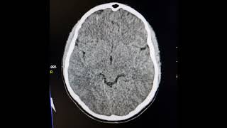 Encephalitis and subarachnoid hemorrhages in a case of Aplastic anaemia [upl. by Nosaes]