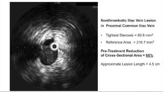 IVUSGuided Deep Venous Stenting [upl. by Rudman]