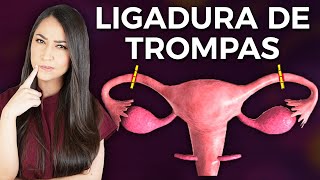 ¿Cómo se hace una LIGADURA DE TROMPAS o salpingoclasia👩🏻‍⚕️ drapauzuniga [upl. by Bedad]