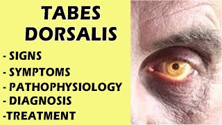 Tabes Dorsalis  Neurosyphilis Tabes Dorsalis  Tabes Dorsalis Signs amp Symptoms medicine [upl. by Karrie478]