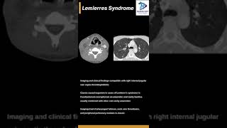 Lemierres syndromeJugular Septic thrombophlebitis with lung nodules [upl. by Clary]