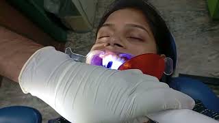 Process of getting fixed retainers after braces by Dr Abhishek Kumar at Magadh Oro Dental patna [upl. by Ahpla]