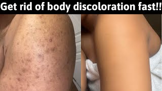 How to get rid of body hyperpigmentationdark spots dark knucklesmelasmascars FAST even skin [upl. by Leirud]