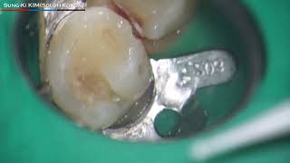 Ceramic bur for deep caries removal [upl. by Faden]