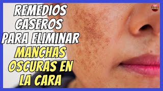 🩷 REMEDIOS CASEROS PARA ELIMINAR MANCHAS OSCURAS EN LA CARA 🩷 [upl. by Nedmac96]