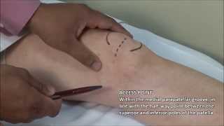 Knee Injection  Medial Approach [upl. by Notnilk916]