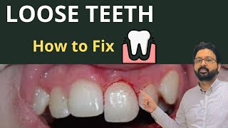 Why Your Teeth Feel LOOSE amp How to Treat TOOTH Mobility [upl. by Attenwad]