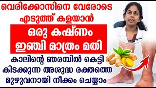 വെരിക്കോസിനെ വേരോടെ എടുത്ത് കളയാൻ ഒരു കഷ്ണം ഇഞ്ചി മാത്രം മതി  vericose veins [upl. by Whang]