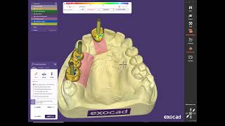 Exocad custom abutment 4th video teeth placement [upl. by Eleirbag]