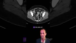 Liver metastases from colorectal cancer radiology medicalstudent radiologist surgeon oncology [upl. by Aicital]