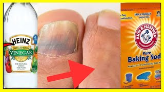 How to Combat Toenail Fungus with Baking Soda and Vinegar [upl. by Nirrep433]