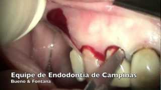 Incisão para Cirurgia Paraendodôntica  Equipe de Endodontia de Campinas [upl. by Joyce]