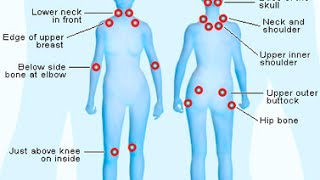 How To Diagnose Fibromyalgia [upl. by Masha]