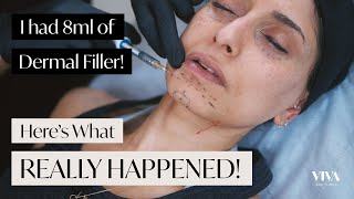 Full Face Dermal Filler 😱 Heres what REALLY happened 2021 [upl. by Neeroc]