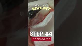 Sealant Procedure Applying the Sealant  In Office to Hands On Dental Training [upl. by Akihsan]