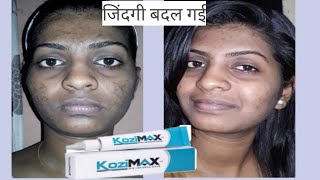 Kozimax Skin Lightening Cream  Uses Side effectsReviews Composition In Hindi [upl. by Obola]