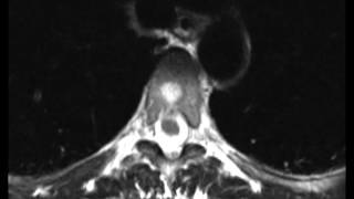 Typical and Atypical Hemangioma [upl. by Ennybor]