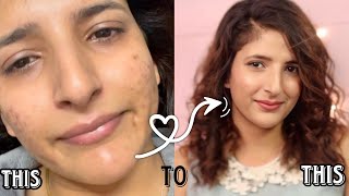 How to get rid of acne scars and acne acnetreatment pimple homeskincare [upl. by Amadas176]