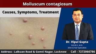 Molluscum contagiosum  Causes Symptoms Treatment [upl. by Arnaldo]