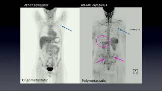 Imaging of bone metastasis  Guiseppe Petralia [upl. by Thorma]