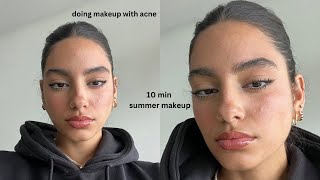 NO FOUNDATION 10 min summer makeup routine with acne [upl. by Yleve771]